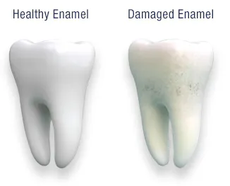 Why Should You Protect Your Tooth Enamel? Pronamel® Toothpaste